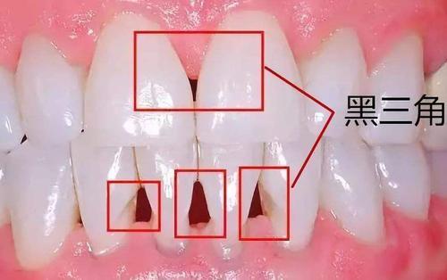 最新特效药在牙龈萎缩治疗中的应用及前景展望