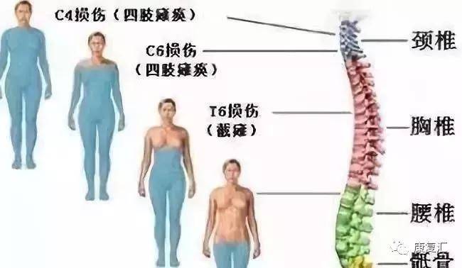 世界脊髓损伤领域取得重大突破，重塑康复希望之光